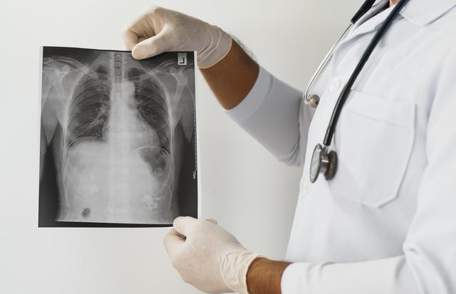 从影像科到临床:肺癌五大非典型信号的技术拆解与实战筛查 健康养生